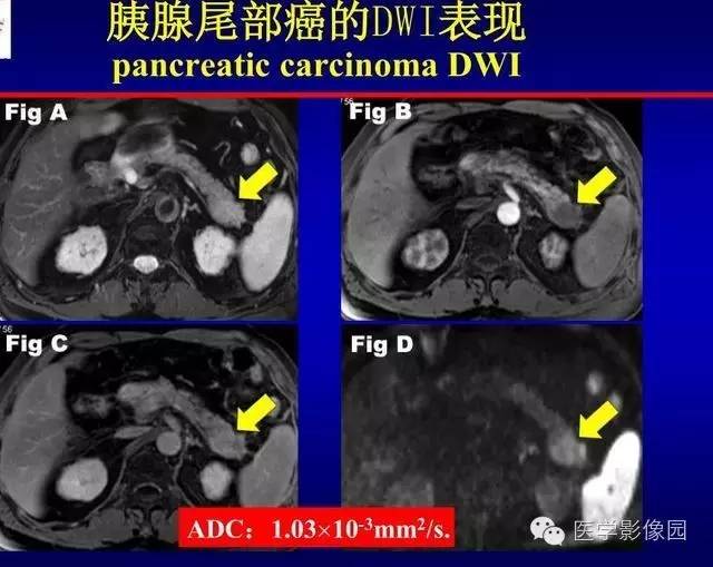 【PPT】胰腺少、罕见病变