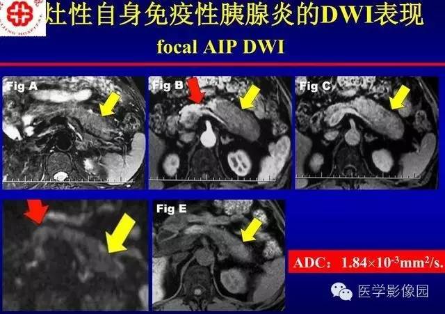 【PPT】胰腺少、罕见病变