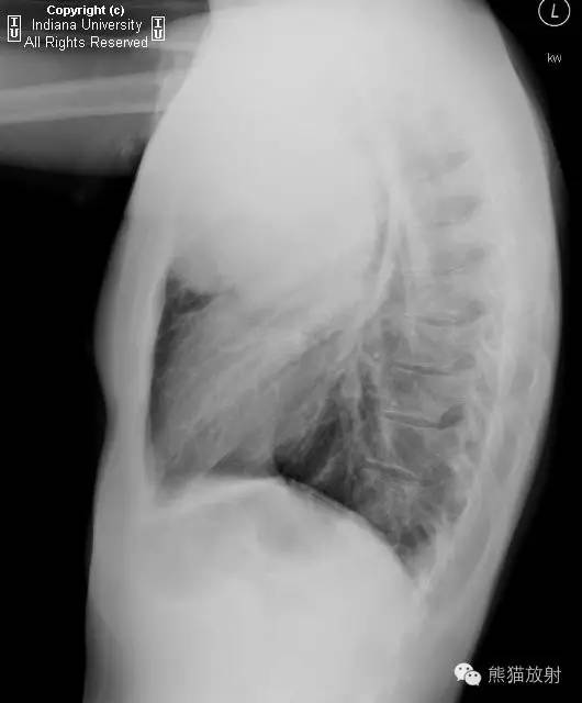 【病例】前纵隔生殖细胞瘤1例CT影像表现 【病例】前纵隔生殖细胞瘤1例CT影像表现