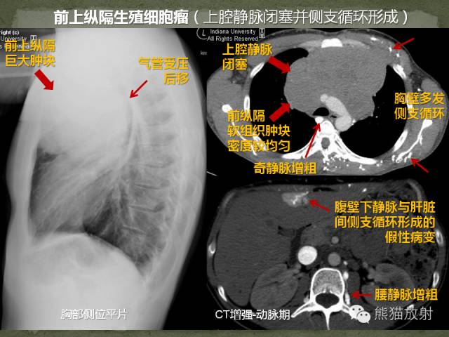 【病例】前纵隔生殖细胞瘤1例CT影像表现