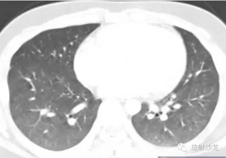 【病例】脂肪栓塞综合征1例CT影像表现