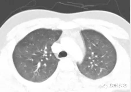 【病例】脂肪栓塞综合征1例CT影像表现