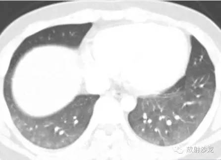 【病例】脂肪栓塞综合征1例CT影像表现