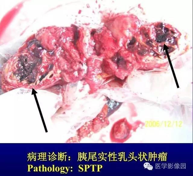 【PPT】胰腺少、罕见病变
