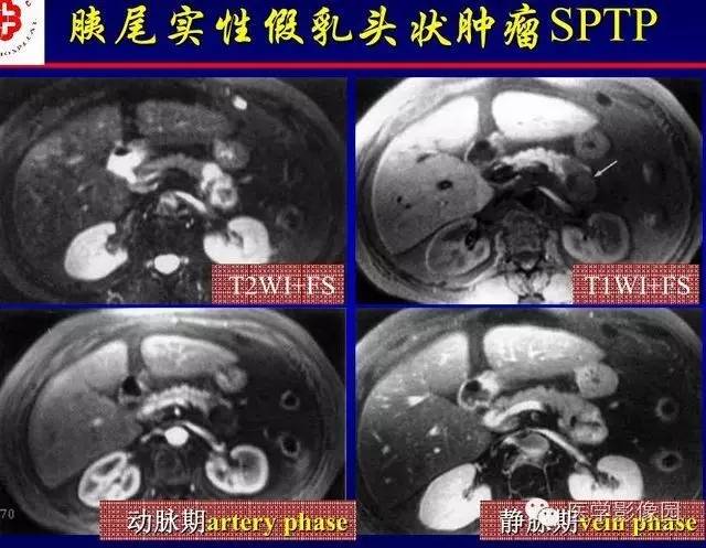 【PPT】胰腺少、罕见病变
