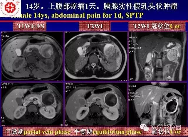 【PPT】胰腺少、罕见病变