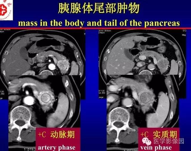 【PPT】胰腺少、罕见病变