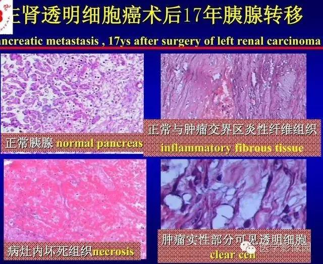 【PPT】胰腺少、罕见病变