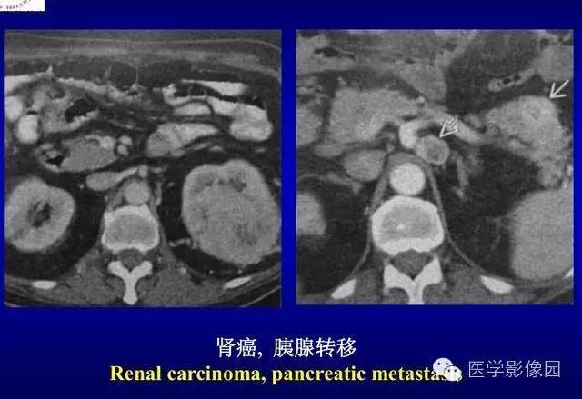 【PPT】胰腺少、罕见病变