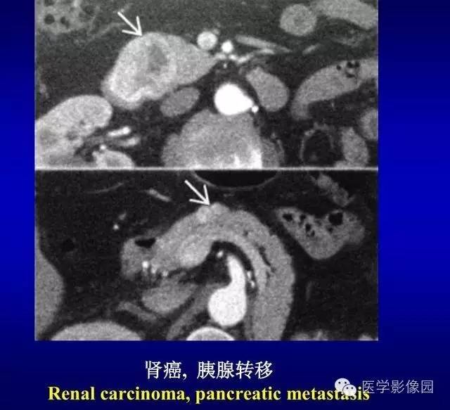 【PPT】胰腺少、罕见病变