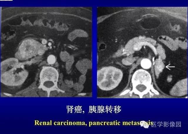 【PPT】胰腺少、罕见病变