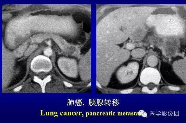 【PPT】胰腺少、罕见病变