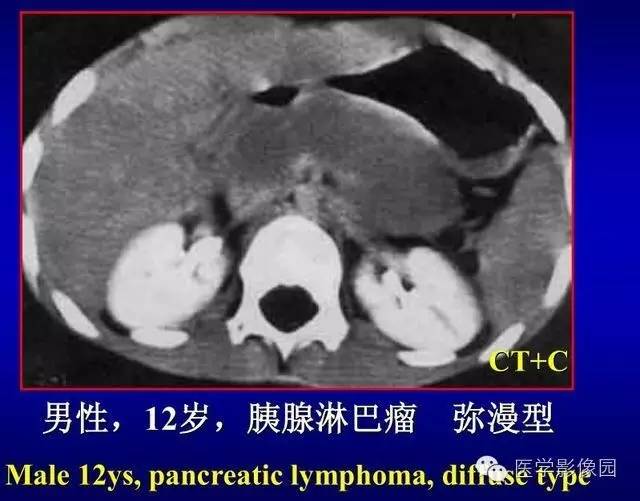 【PPT】胰腺少、罕见病变