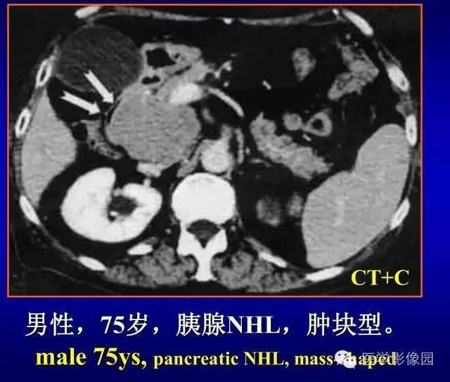 【PPT】胰腺少、罕见病变