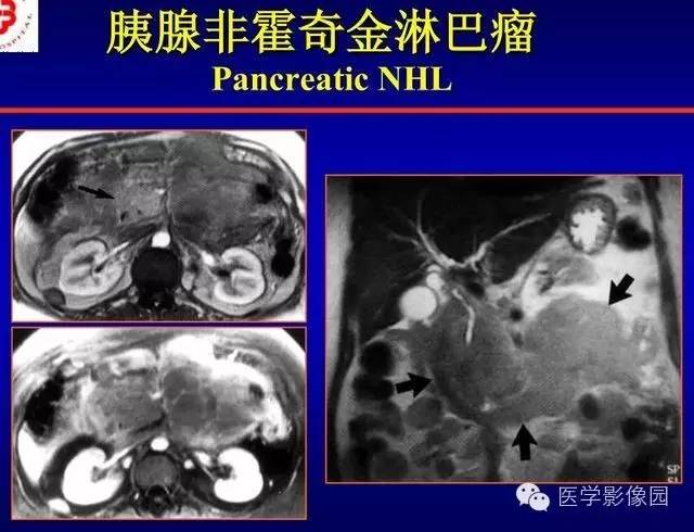 【PPT】胰腺少、罕见病变