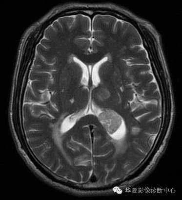 【病例】左侧脑室室管膜下瘤1例MR