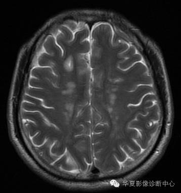 【病例】左侧脑室室管膜下瘤1例MR