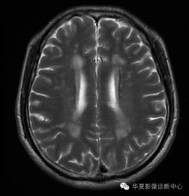 【病例】左侧脑室室管膜下瘤1例MR