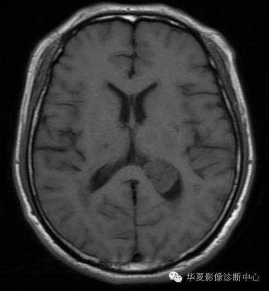 【病例】左侧脑室室管膜下瘤1例MR