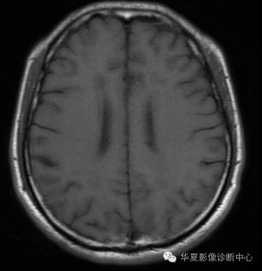 【病例】左侧脑室室管膜下瘤1例MR