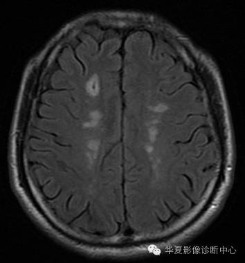 【病例】左侧脑室室管膜下瘤1例MR