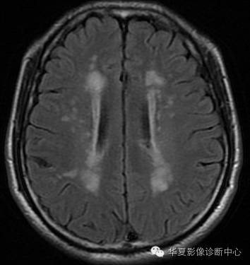 【病例】左侧脑室室管膜下瘤1例MR