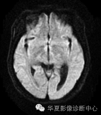 【病例】左侧脑室室管膜下瘤1例MR
