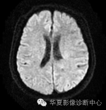 【病例】左侧脑室室管膜下瘤1例MR