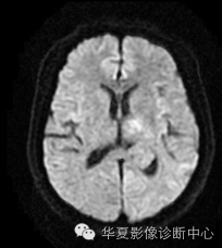 【病例】左侧脑室室管膜下瘤1例MR