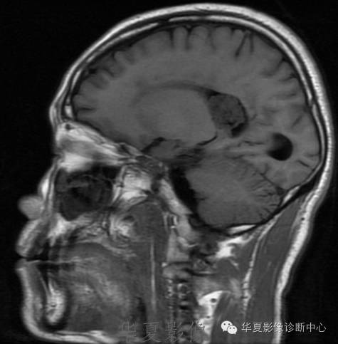 【病例】左侧脑室室管膜下瘤1例MR