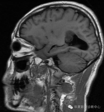 【病例】左侧脑室室管膜下瘤1例MR
