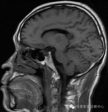 【病例】左侧脑室室管膜下瘤1例MR
