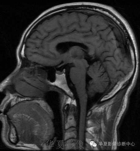 【病例】左侧脑室室管膜下瘤1例MR