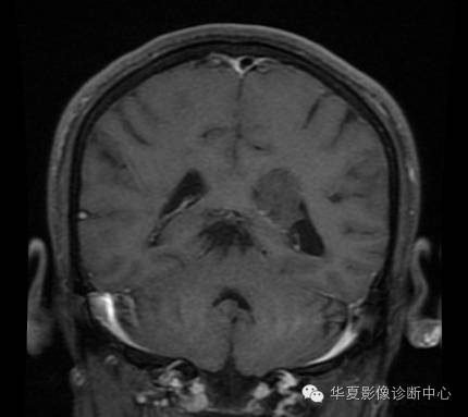 【病例】左侧脑室室管膜下瘤1例MR