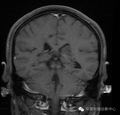 【病例】左侧脑室室管膜下瘤1例MR