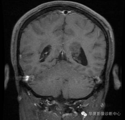 【病例】左侧脑室室管膜下瘤1例MR