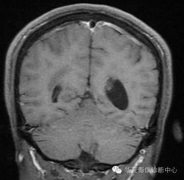 【病例】左侧脑室室管膜下瘤1例MR
