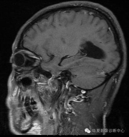 【病例】左侧脑室室管膜下瘤1例MR