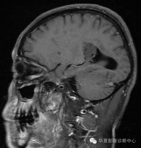 【病例】左侧脑室室管膜下瘤1例MR