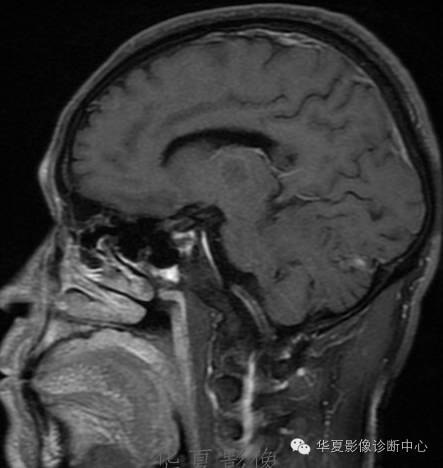【病例】左侧脑室室管膜下瘤1例MR