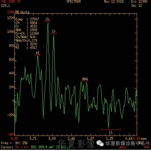 【病例】左侧脑室室管膜下瘤1例MR