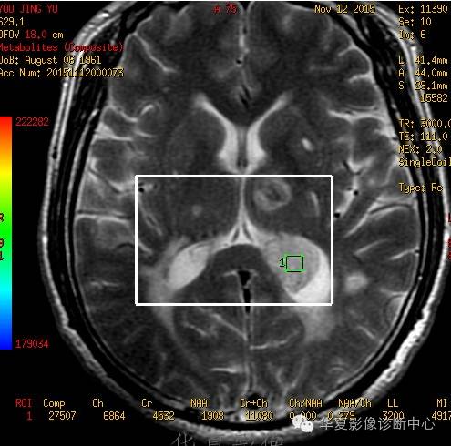 【病例】左侧脑室室管膜下瘤1例MR