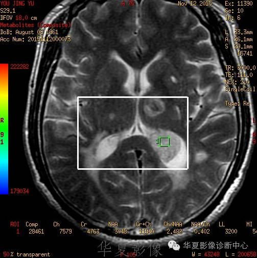 【病例】左侧脑室室管膜下瘤1例MR