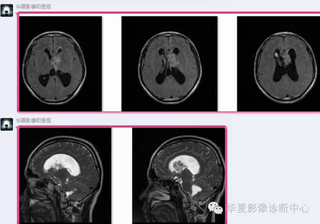 【病例】左侧脑室室管膜下瘤1例MR