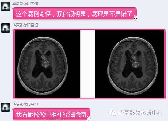 【病例】左侧脑室室管膜下瘤1例MR