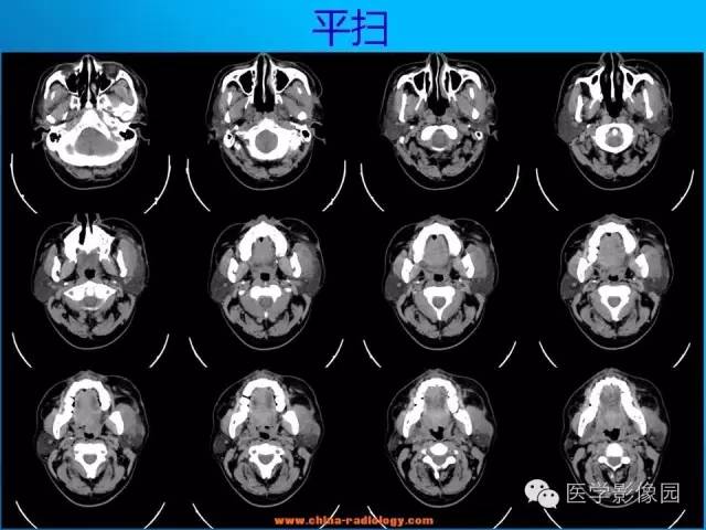 【病例】左面部朗格汉斯细胞组织细胞增生症1例CT