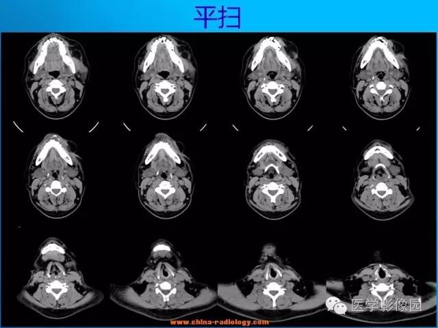 【病例】左面部朗格汉斯细胞组织细胞增生症1例CT