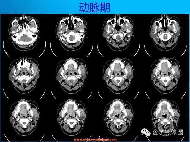 【病例】左面部朗格汉斯细胞组织细胞增生症1例CT