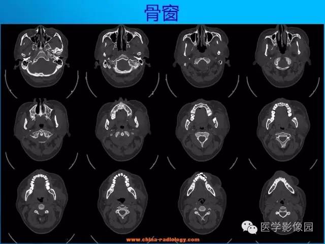 【病例】左面部朗格汉斯细胞组织细胞增生症1例CT
