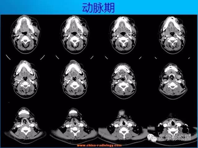 【病例】左面部朗格汉斯细胞组织细胞增生症1例CT